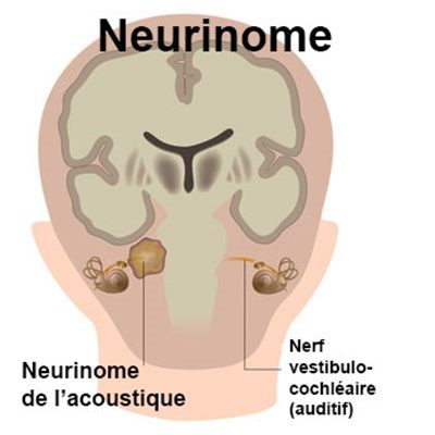Neurinome de l'acoustique
