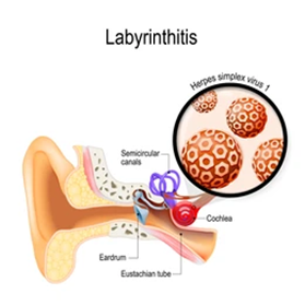 Labyrinthite. neurite vestibulaire. inflammation de l'oreille interne 